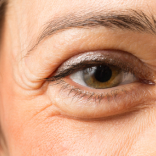 Wrinkle Relaxer for Crows Feet