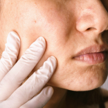 Hydra Facial for Uneven Skin Tone 