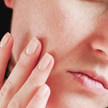 Hydra Facial for Congested Pores