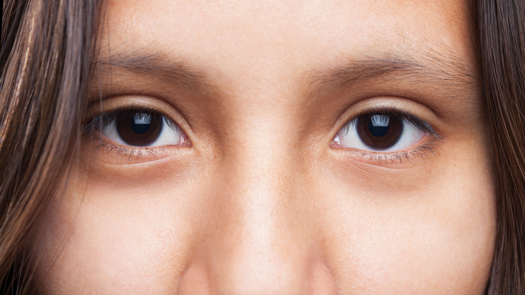 under eye fillers for dark circles